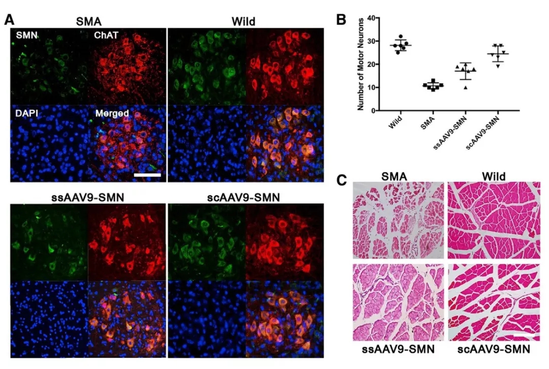 与时间赛跑，基于rAAV9载体胎儿基因治疗SMA新进展（一）