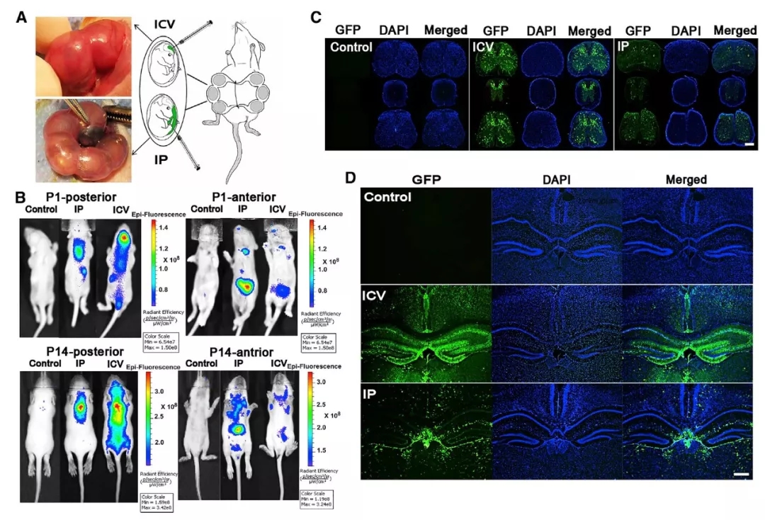 与时间赛跑，基于rAAV9载体胎儿基因治疗SMA新进展（二）